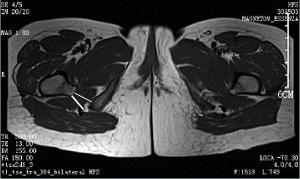 坐骨股骨撞击综合征的MRI诊断价值研究